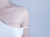 Reconstruction des seins après cancer