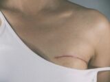Techniques pour reconstruire les seins